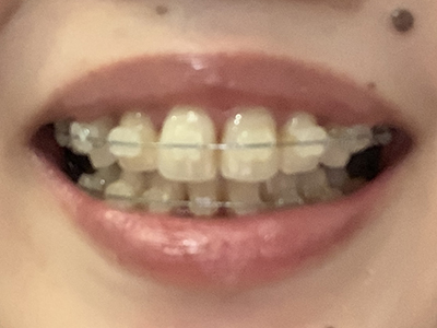 歯列矯正　前からの写真